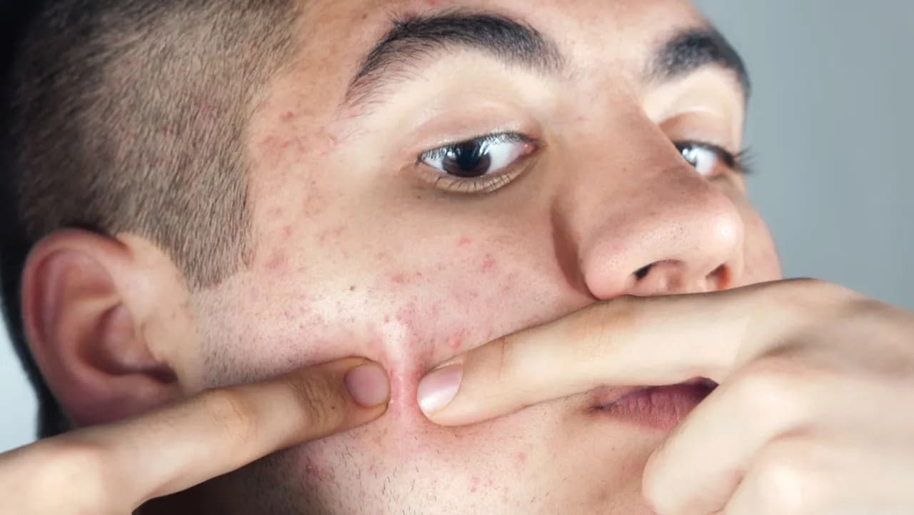 Skuteczne sposoby na pryszcze na twarzy, które naprawdę działają Skuteczne sposoby na pryszcze na twarzy, które naprawdę działają