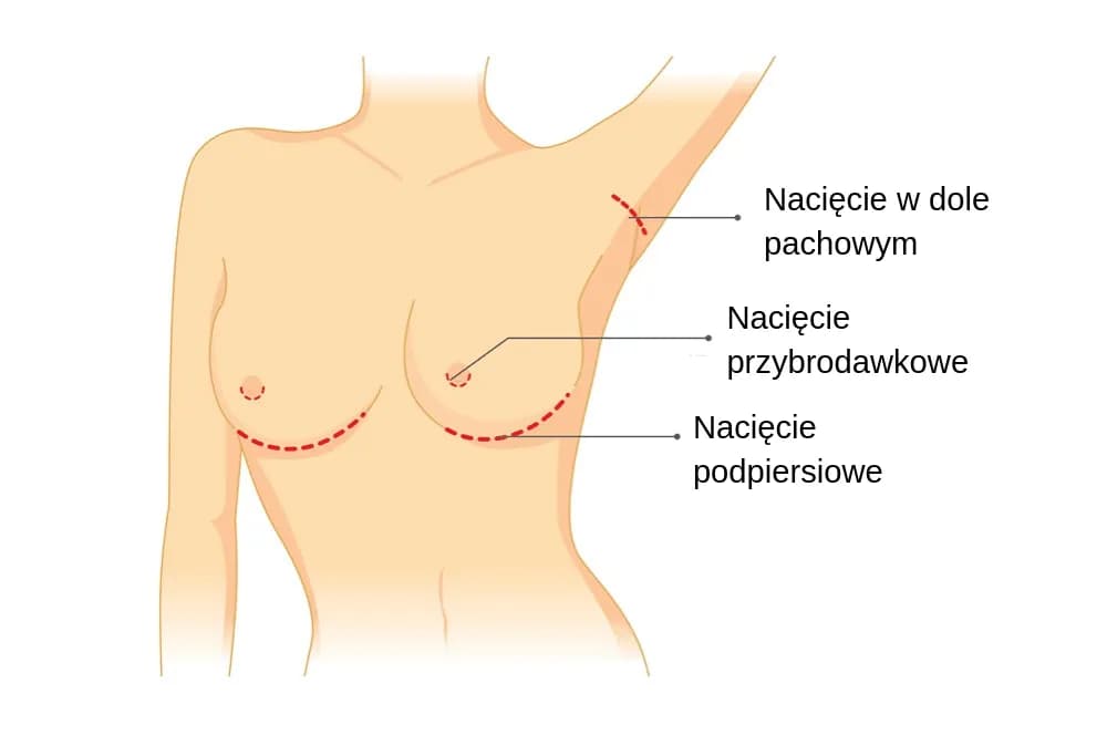 Ile kosztuje operacja plastyczna biustu? Ceny i ukryte wydatki